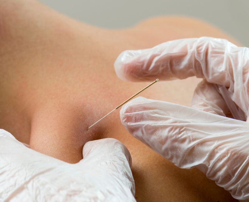 Benefits of Dry Needling Therapy