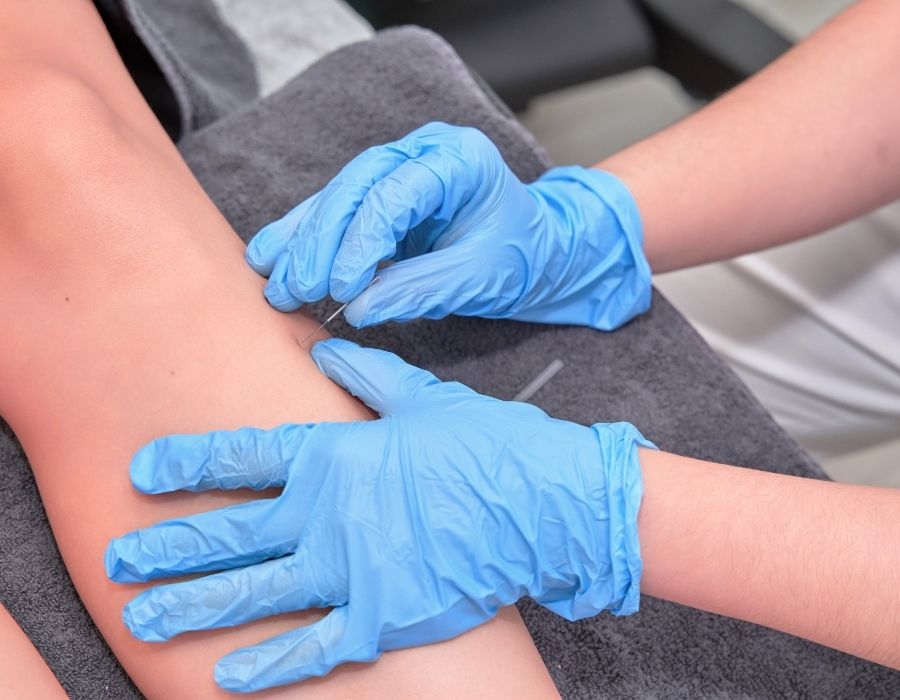 dry needling for knee pain relief